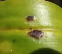 edema